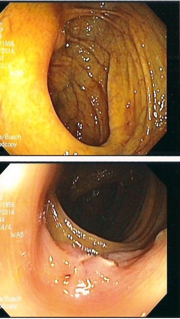 Two of six photos of my colon given to me after the procedure.