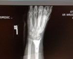 wrist x-ray –&nbsp;Copy
