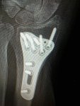 implant xray –&nbsp;Copy