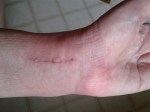Wrist incision close-up